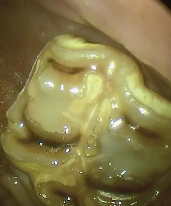 Endoscopic view of a horse’s cheek tooth after restoration, showing a smooth, clean chewing surface with normal enamel folds.
