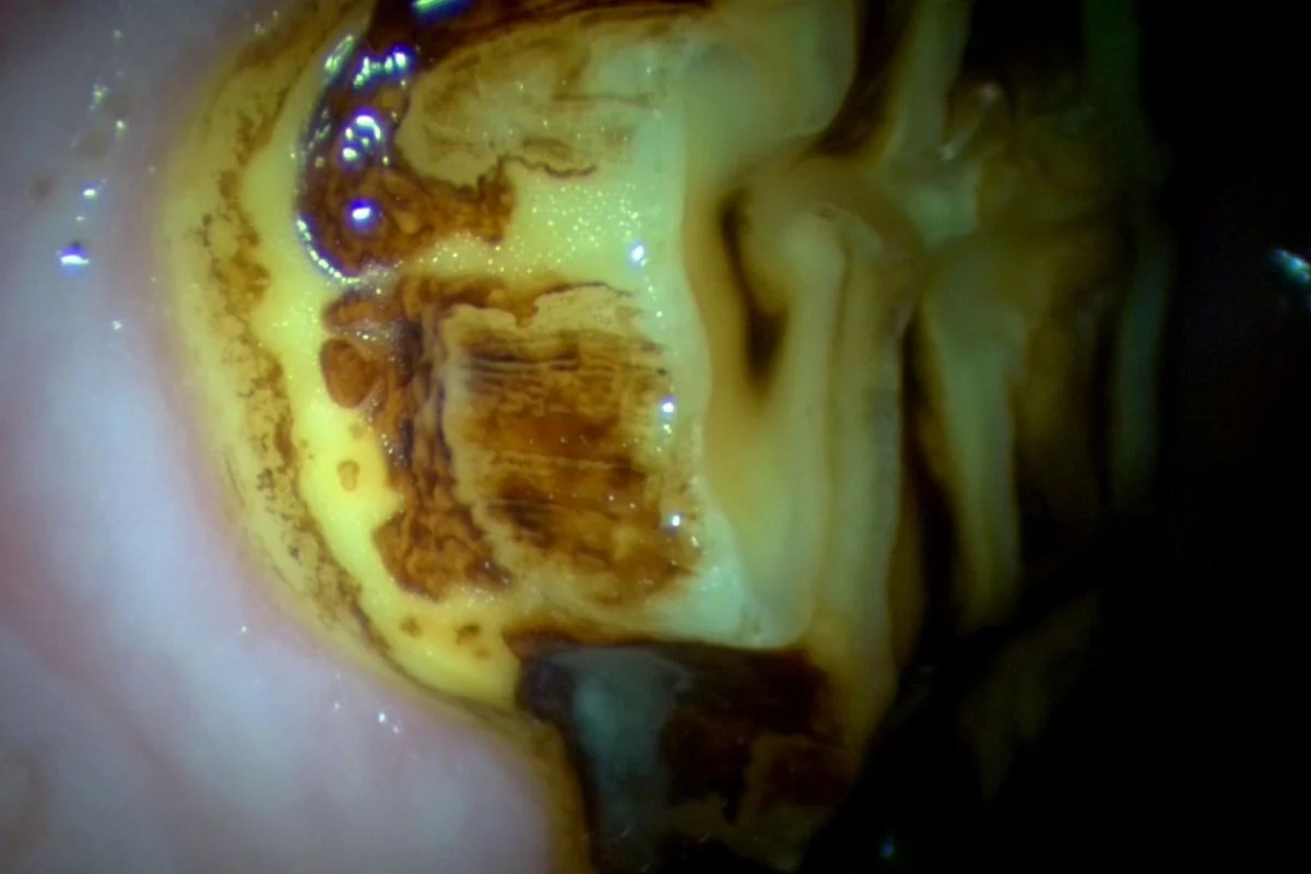 How do we diagnose peripheral caries?