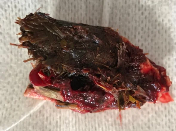 Removed fragment of a severely diseased horse tooth packed with rotting feed material and visible infection.