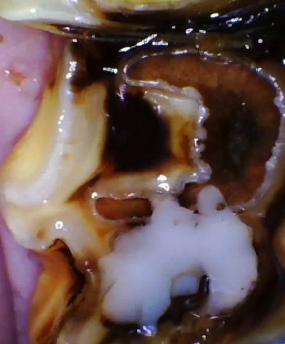 Close-up of a horse’s molar showing severe decay and discoloration, with a white restorative material placed in the centre of the tooth.