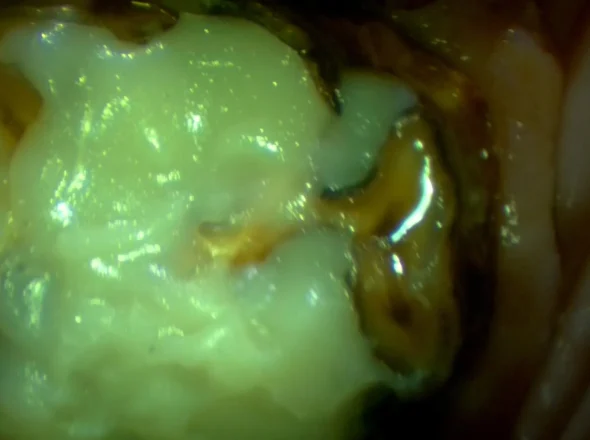 Close-up of a horse’s tooth filled with white dental restoration material after caries removal.