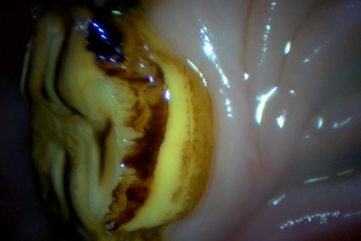 What are the treatment options?