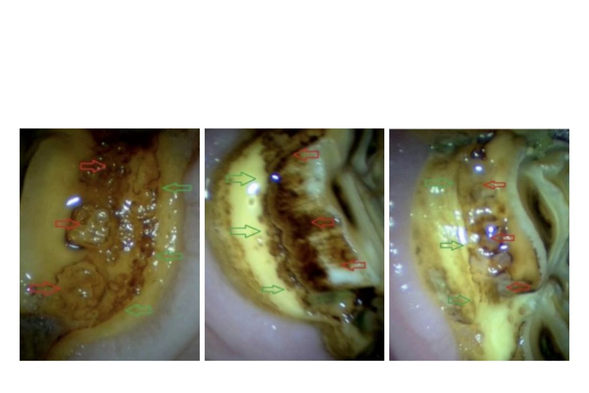 What are peripheral caries?