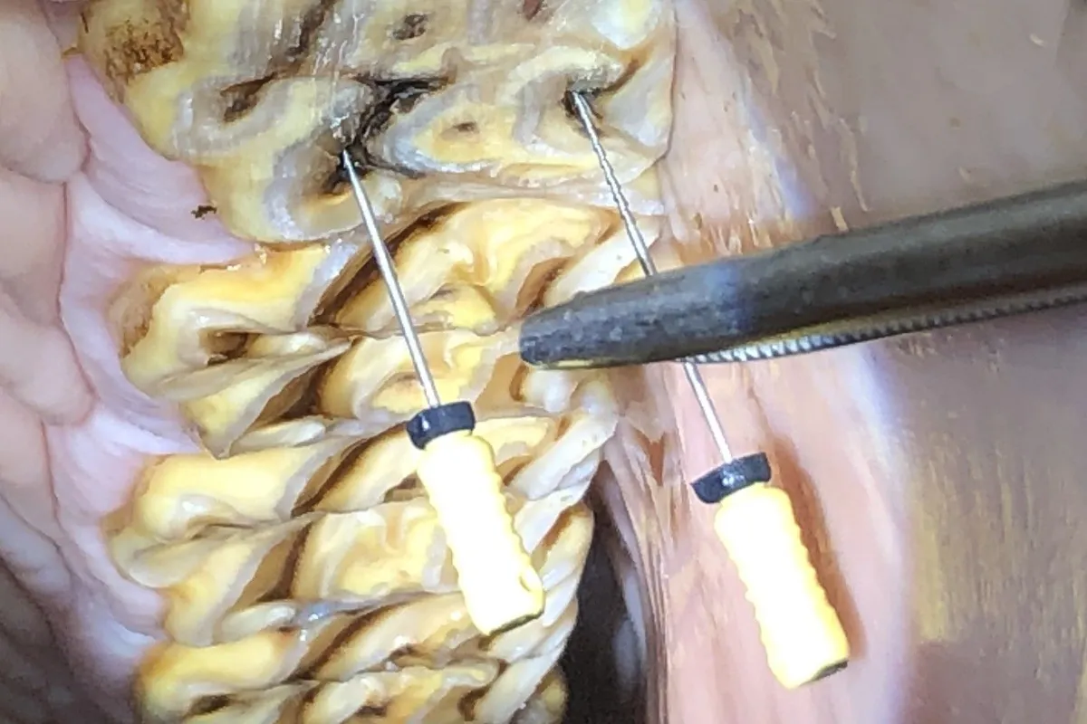 Tooth undergoing root canal treatment, with endodontic files used to clean and disinfect the infected pulp canals.